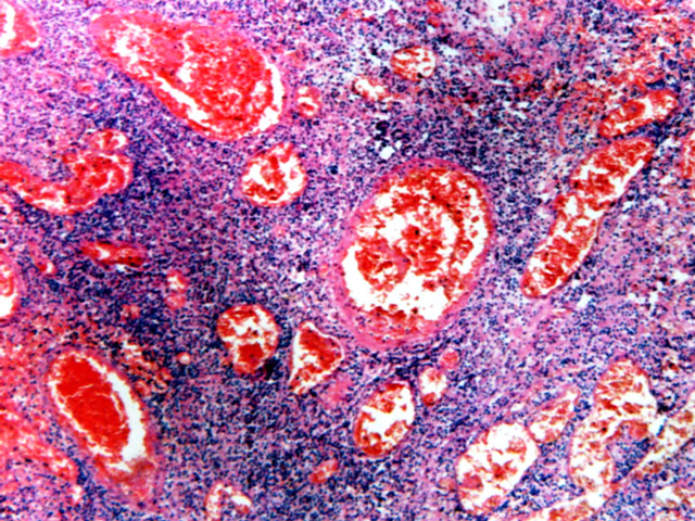 Fig. 28: Linfoma T/NK en Orofarnge. - <div style=